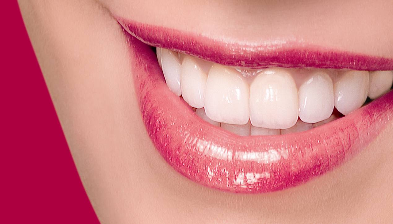 VENEERS LUMINEERS